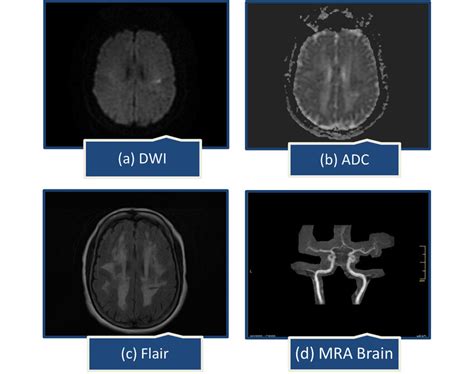 MRI STROKE PROTOCOL A B Small Acute Ischemic Infarct In Left Centrum