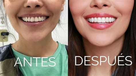 ¡conoce Todo Lo Que Debes Saber Sobre El Diseño De Sonrisa