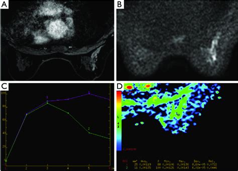 Mri Imaging In A 45 Year Old Woman A Contrast Enhanced Breast Mri