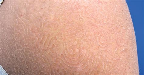 Tinea Imbricata Nedir Belirtileri Nedenleri Tanısı Ve Tedavisi