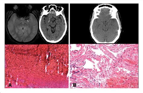 A Blooming Artifact On Gradient Echo Mri Sequence And Hyperdense