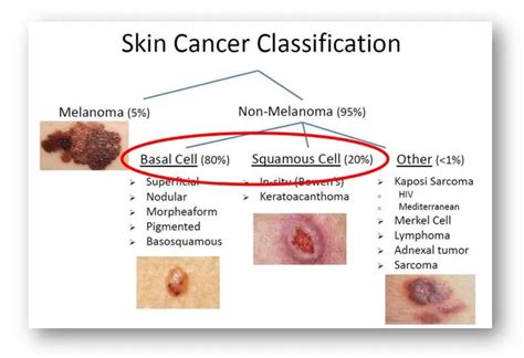 Basal Cell Carcinoma Vs Squamous Cell Carcinoma