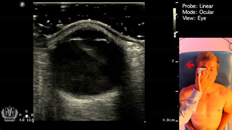 Ocular Ultrasound Basics Made Simple YouTube