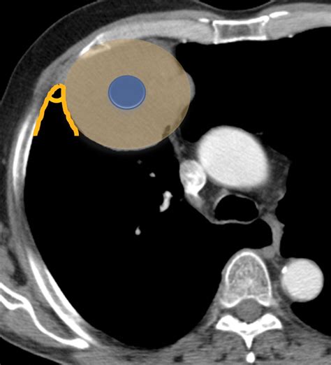 Tumorlike Conditions Of The Pleura Radiographics