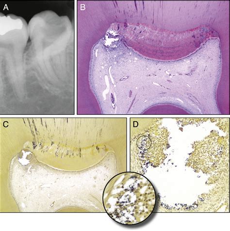 Figure 1 From Correlation Between Clinical And Histologic Pulp