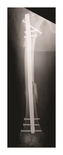 A Ap Radiographs Of A Patient With Atypical Femoral Shaft Fracture Download Scientific