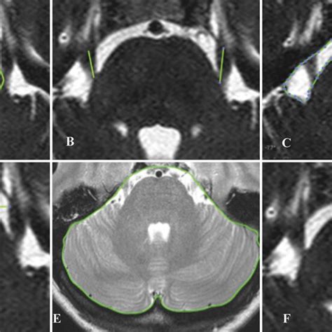 Representative Axial T2 Weighted MR Images Showing The Measurements