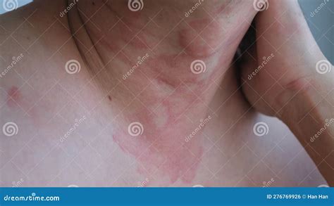 Close Up Image Of Skin Texture Suffering Severe Urticaria Or Hives