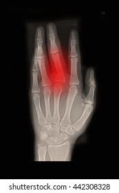 Closed Fracture Middle Finger Left Hand Stock Photo 442308328 | Shutterstock