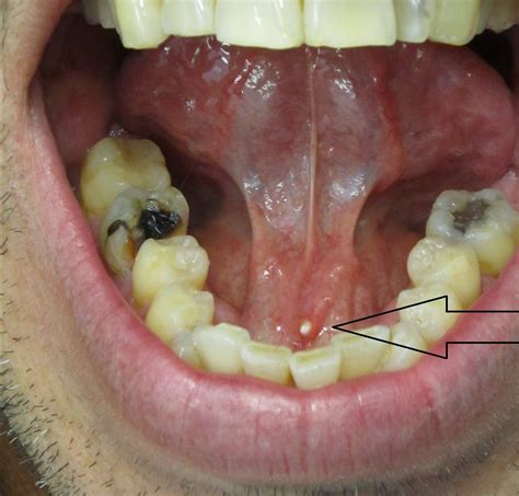 Submandibular Duct