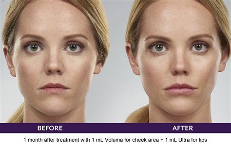 Juvederm Cheeks