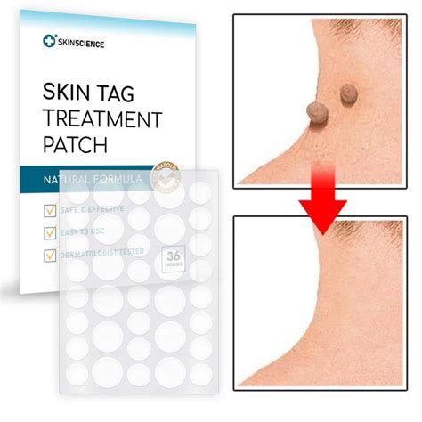 Skin Tag Spot Treatment Patch