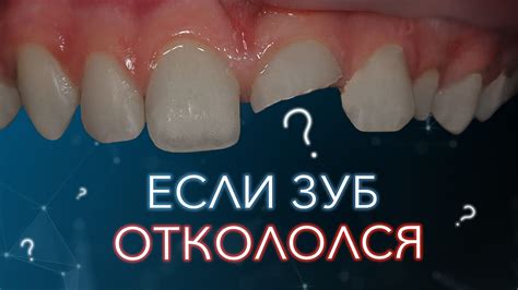 Откололся зуб. Что с этим делать? - YouTube