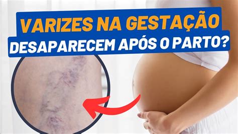 Varizes Na Gravidez Desaparecem Ap S O Parto Descubra A Verdade Dr