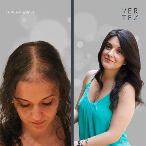 Vertex Hair Clinic Hospitals Clinics Medical Travel Market