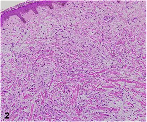 Multiple Well Demarcated Skin Colored Papules And Nodules Jaad Case Reports