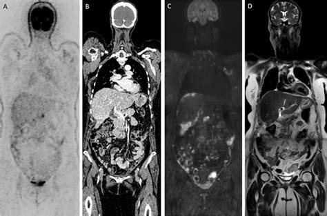 Whole Body Diffusion Weighted Mri In Ovarian Cancer Staging Journal