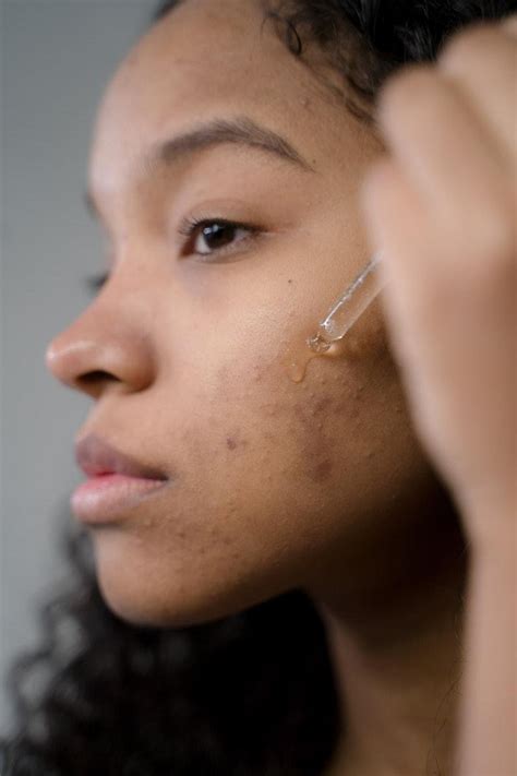 Pie Vs Pih Different Types Of Acne Scars Glowy Ai