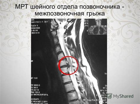 Презентация на тему: "Презентация на тему: Остеохондроз шейного отдела ...