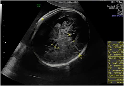 Case Report Of Congenital Myotonic Dystrophy With Multiple Prenatal