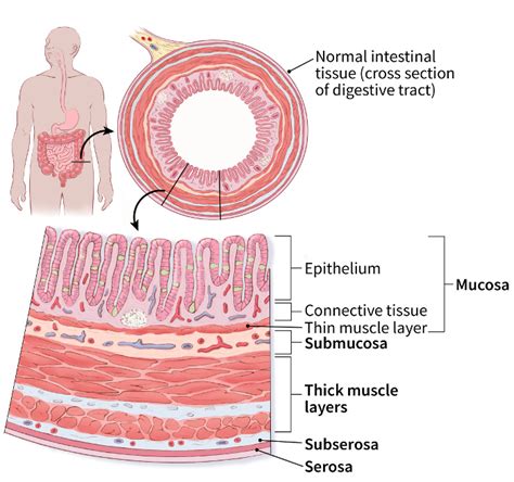 Gastrointestinal Carcinoid Tumor Stages