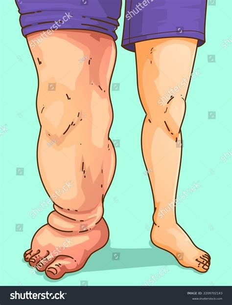 Lymphedema Edema Medical Illustration Vector Royalty Free Stock