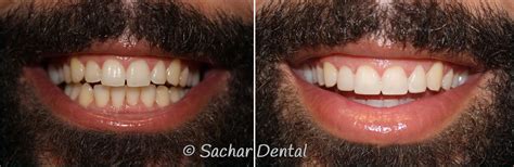 Sachar Dental Nyc Before After Pictures Top Nyc Dentist