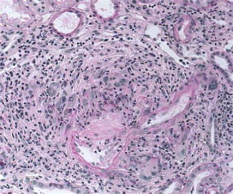 Granulomatous Interstitial Nephritis The Granuloma Is Connected To The Download Scientific