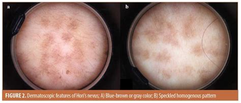 A Comparative Study Of Dermatoscopic Features Of Melasma And Horis