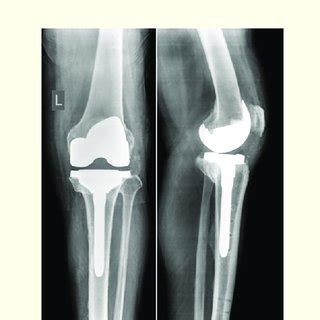 A And B Anteroposterior Ap And Lateral Radiograph At Year Follow