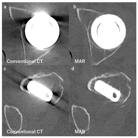 Diagnostics Free Full Text Advances In Bone Joint Imaging Metal Artifact Reduction