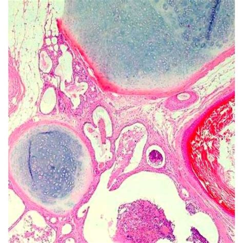 Photomicrographs Of Specimen Of Lung Showing Benign Mature Teratoma