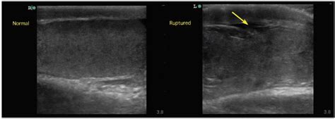 Testicular Rupture Ultrasound