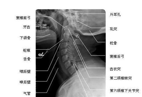 颈椎侧位 X线片 解剖图片 Medscicn