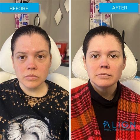 Before And After Cheek Filler Align Injectable Aesthetics