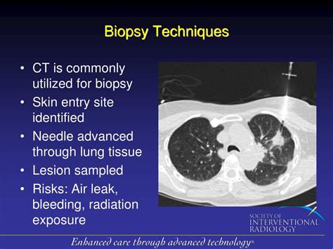 Ppt Lower Dosage Ct Guided Lung Biopsy Protocol Maintains Quality