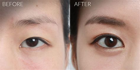 Double Eyelid Surgery Everything You Need To Know The Daily Glimmer