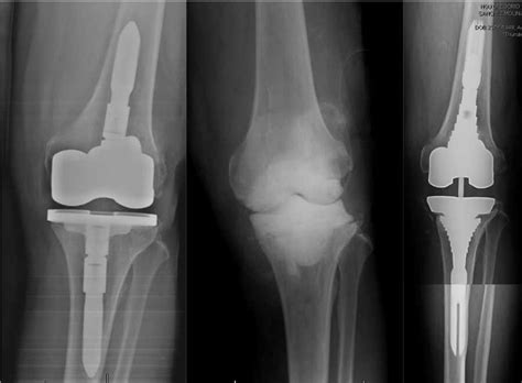 Infección de Prótesis de Rodilla