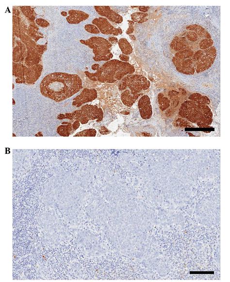 Tonsillar Cancer Staging