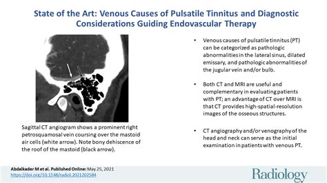 State Of The Art Venous Causes Of Pulsatile Tinnitus And Diagnostic Considerations Guiding