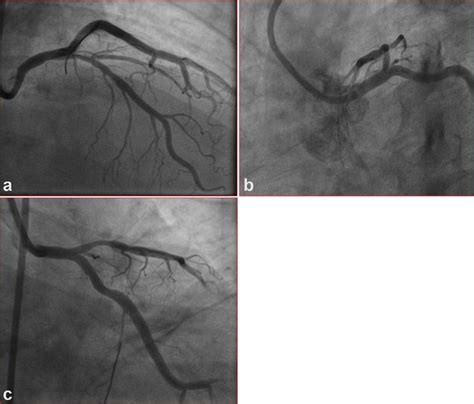 Left Main Coronary Artery Spasm: Case Report - Indian Journal of ...