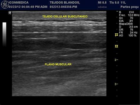 Ecografía de Tejidos Blandos Ecografías Bogotá Norte Colombia