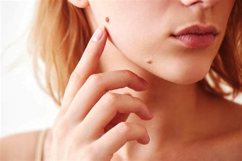 Skin Moles Removal Easy And Safe Ways Recommended By Dermatologist