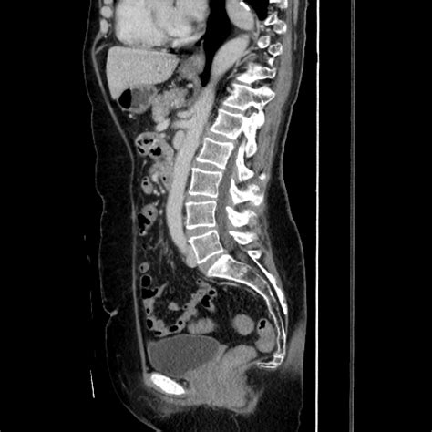 Non Occlusive Ischemic Colitis Image Radiopaedia Org