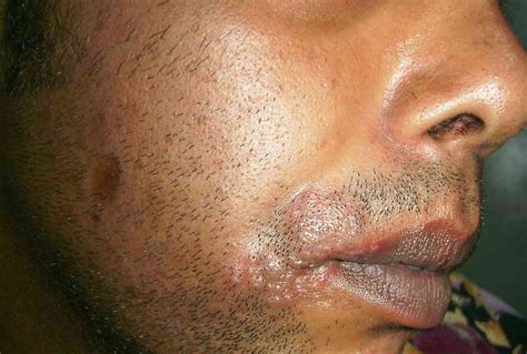 Herpes Simplex Skin Rash