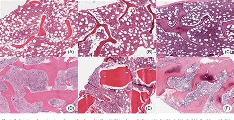 Osteosclerosis Bone