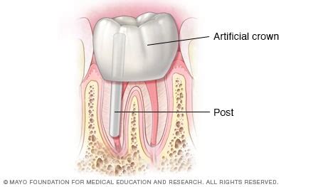 how does a crown work after a root canal - Hwa Bullard