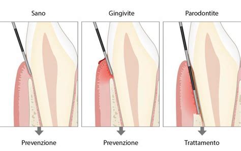 Diagnosi Della Parodontite Ulteriori Informazioni Periodontal Health