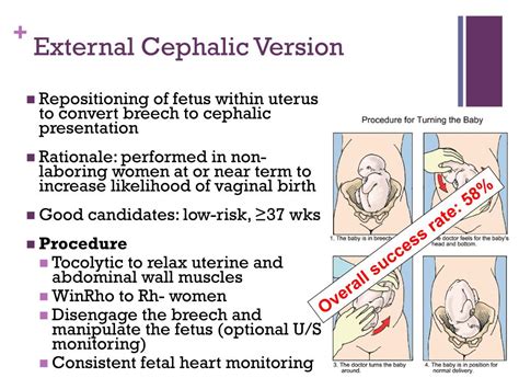 PPT - Breech Presentation PowerPoint Presentation, free download - ID:6051090