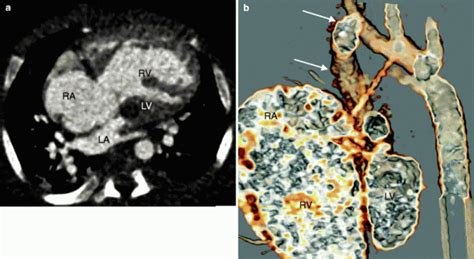 Heterotaxy Syndrome | Radiology Key